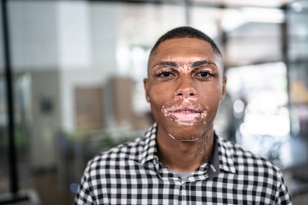 (BPRW) FDA Approves First At-Home Topical Treatment for Vitiligo | Press releases